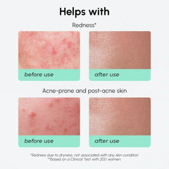 Redness Soothing Azelaic Acid Serum